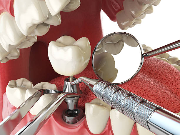 Best Tooth Infection Emergency Dentist  in Montgomery, IN